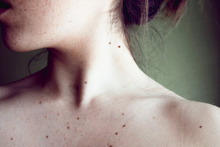 Травма родинки: может ли вызвать рак кожи и как оказать себе первую помощь