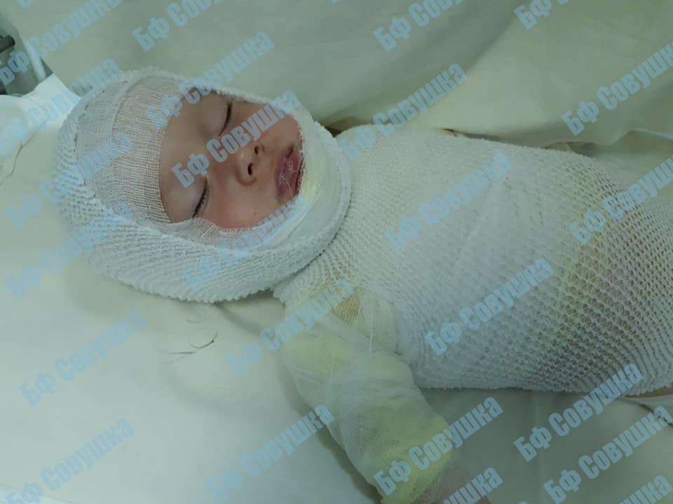 Нужна помощь: в Днепре 2-летний малыш перевернул на себя кружку с кипятком