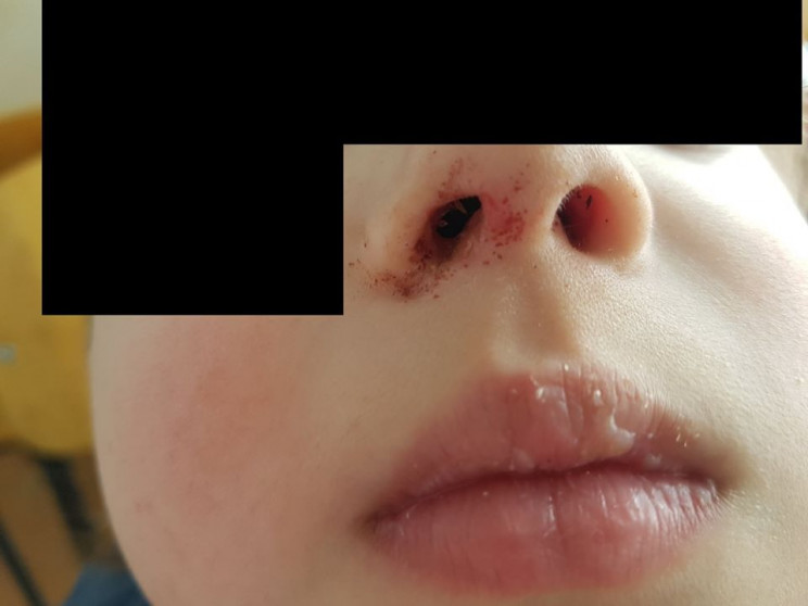 В Днепре врачи спасли мальчика, у которого в носу застряла батарейка (ФОТО)