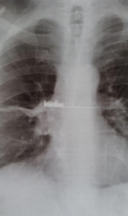 Днепрянин почти месяц ходил с зубным протезом в бронхах - рис. 1