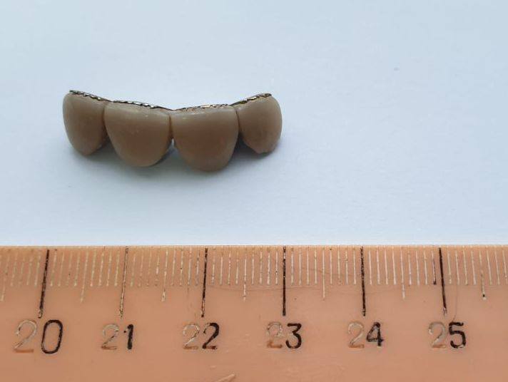 Днепрянин почти месяц ходил с зубным протезом в бронхах - рис. 2