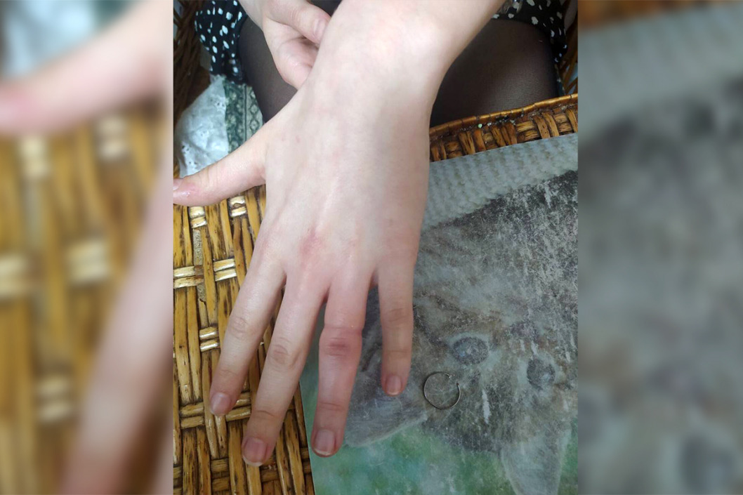 В Днепре девушка из-за тесного кольца едва не лишилась пальца (ФОТО) - рис. 3