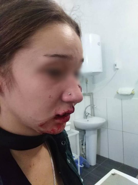 В Днепре прооперировали девочку, которую сильно покусала собака - рис. 3