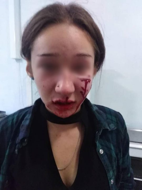 В Днепре прооперировали девочку, которую сильно покусала собака - рис. 2