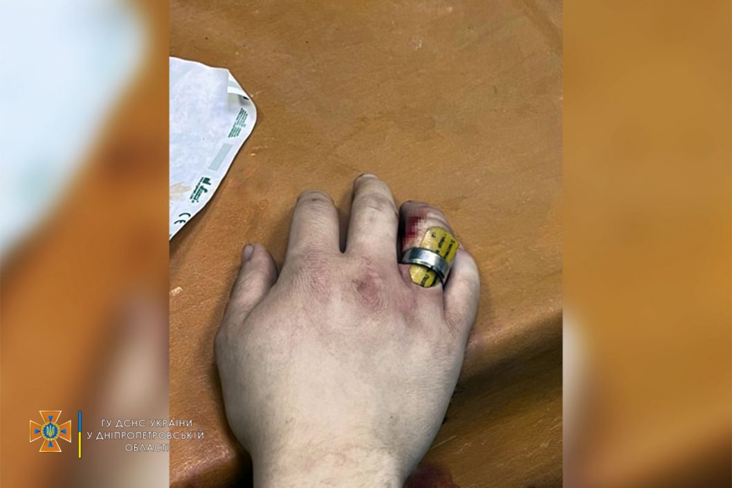 Коварное украшение: в Днепре спасатели помогли 17-летнему подростку снять кольцо с пальца - рис. 1
