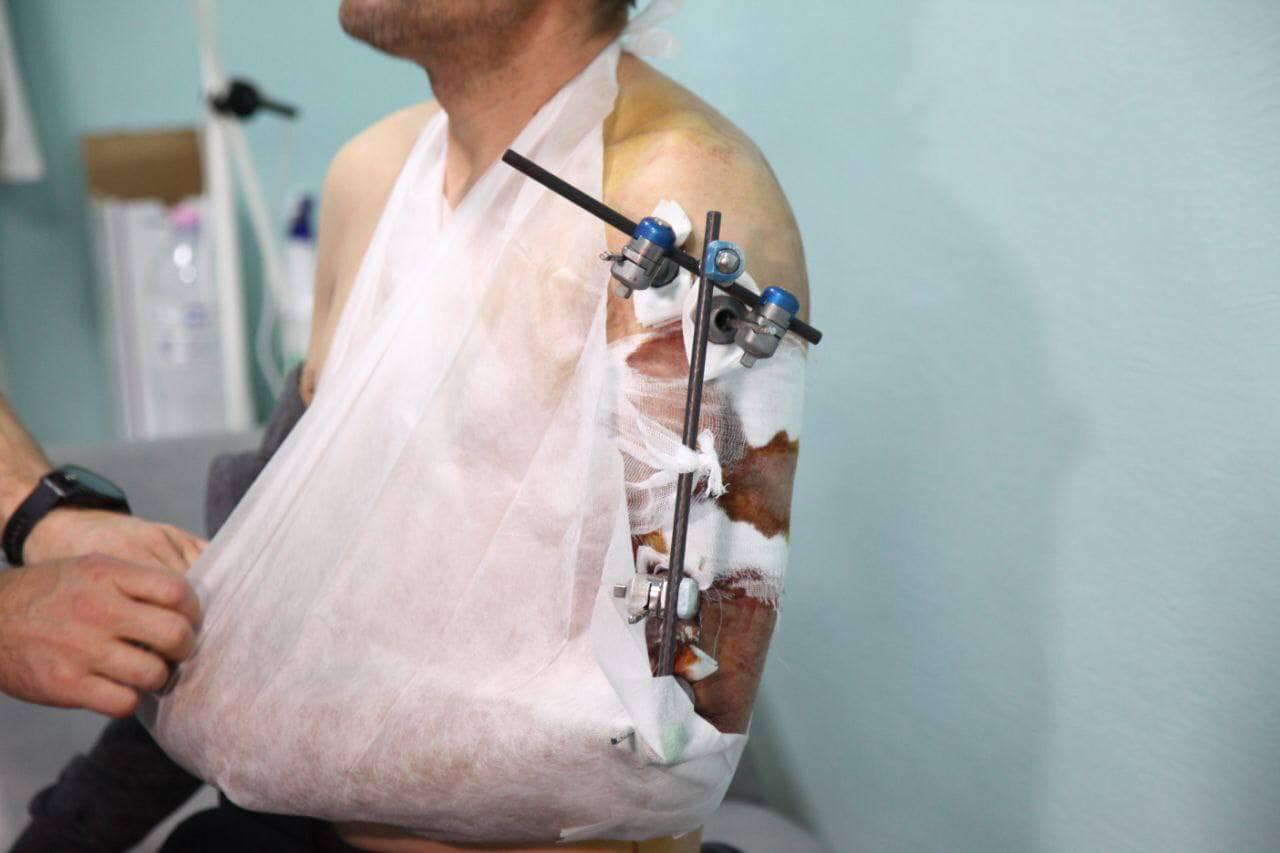 Сложные переломы и жгучая боль: в Днепре спасли солдата ВСУ с тяжелым ранением - рис. 1