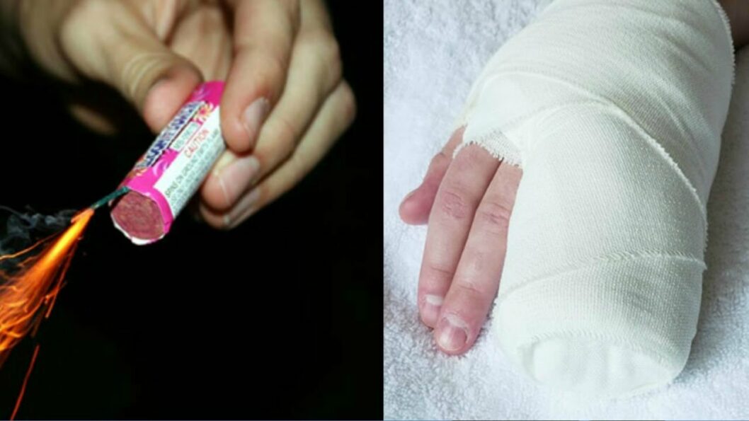 На Дніпропетровщині 21-річному хлопцеві відірвало петардою палець