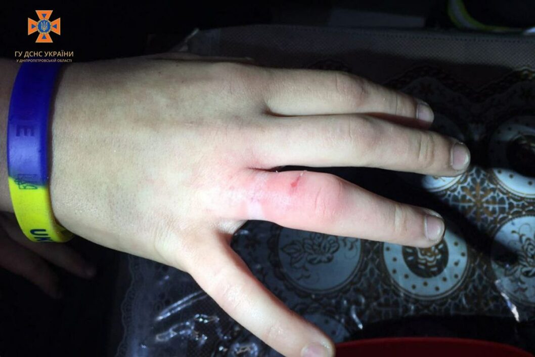 У Дніпрі надзвичайники допомогли підлітку зняти каблучку з пальця - рис. 2