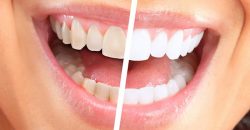 Що важливо знати про відбілювання зубів?