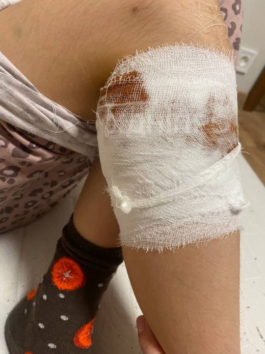 В Днепре стая собак покусала ребенка - рис. 1