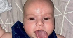 В Україні вперше прооперували малюка з уп'ятеро довшим за норму язиком