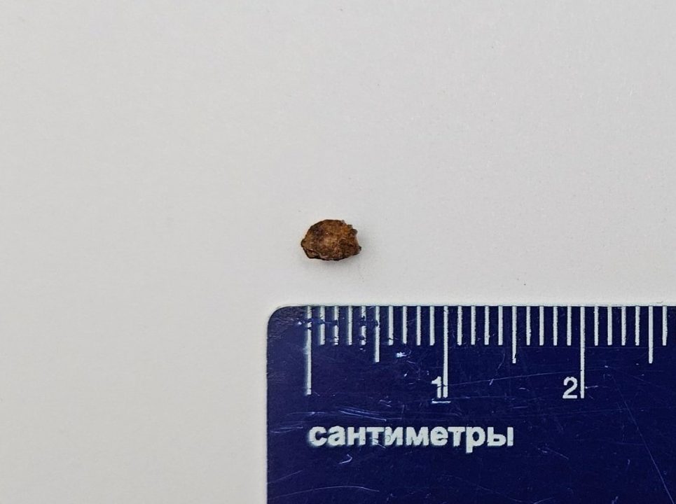 У Дніпрі врятували однорічну дитину, яка проковтнула камінь - рис. 2