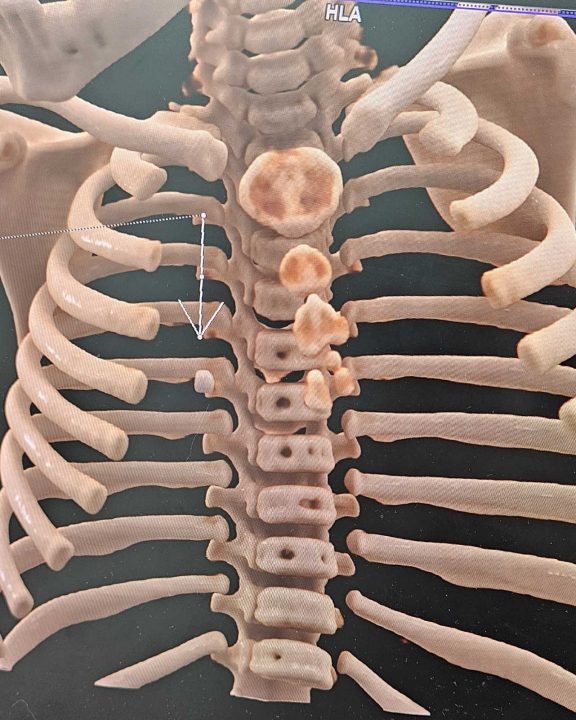 У Дніпрі врятували однорічну дитину, яка проковтнула камінь - рис. 1