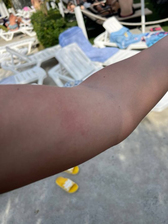 Дніпряни скаржаться на подразнення шкіри після купання в аквапарку