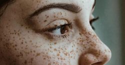 Веснушки на лице: почему они появляются и как убрать веснушки