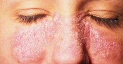 Псориаз: причины, симптомы, виды и лечение - рис. 1