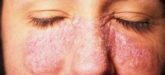 Псориаз: причины, симптомы, виды и лечение