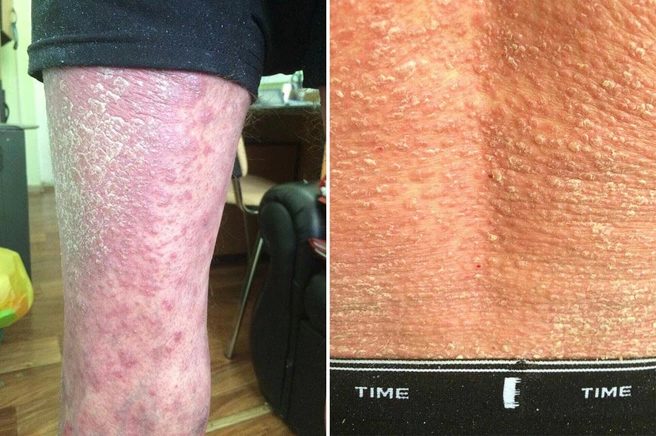 Псориаз: причины, симптомы, виды и лечение