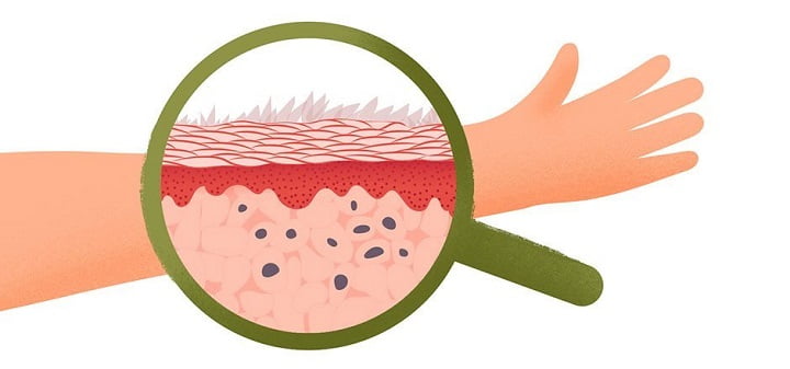 Псориаз: причины, симптомы, виды и лечение